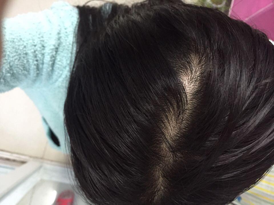 23岁<em>女生掉头发严重</em>怎么办?发际线和头顶漩涡