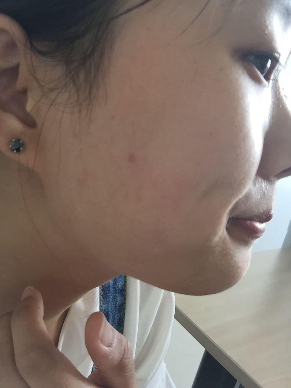 女,25岁,脸上开始长棕色的斑,怎么办?