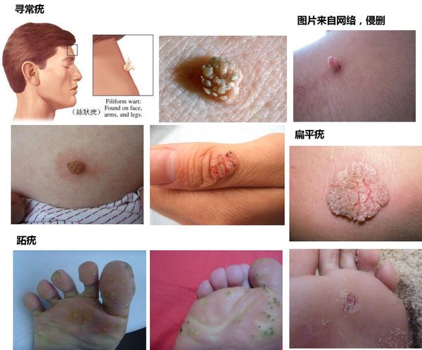人头乳瘤病毒早期症状_人乳头瘤病毒 症状_人乳瘤病毒女性症状