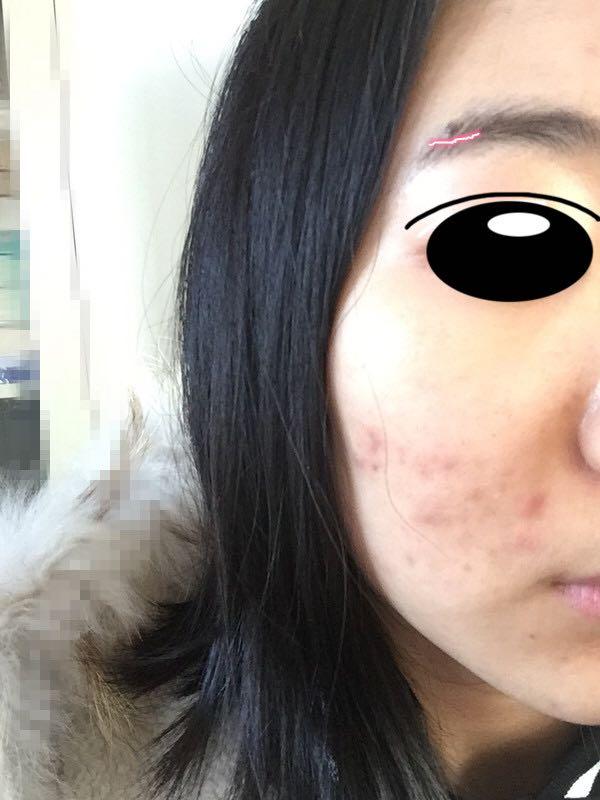 本人发型脸上长很多痘,?-王山而的回答半女生女生扎图片