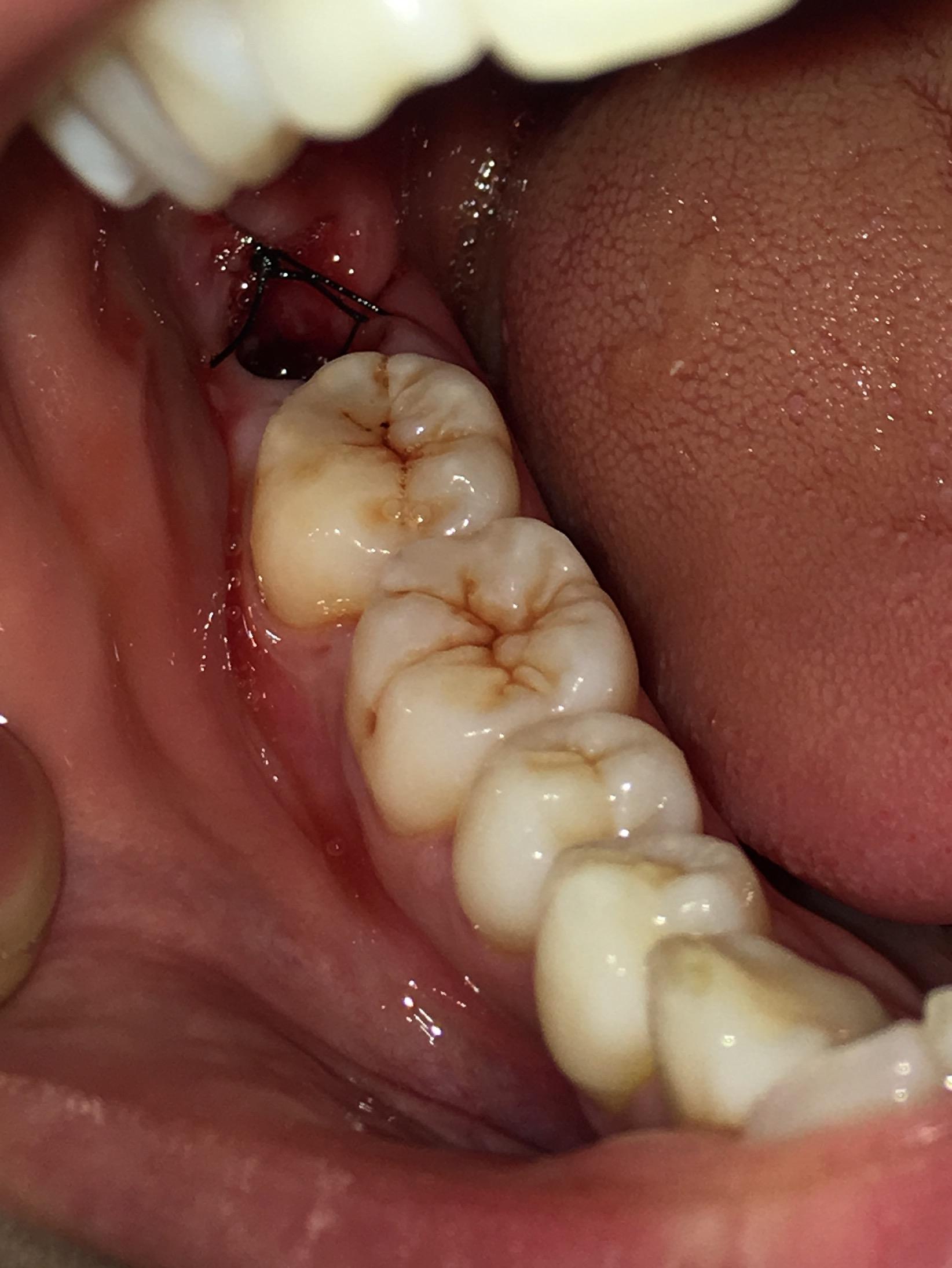 刚拔完牙拍的照片,右边智齿拔出来以后有个明显的洞,缝线的… 拔牙24