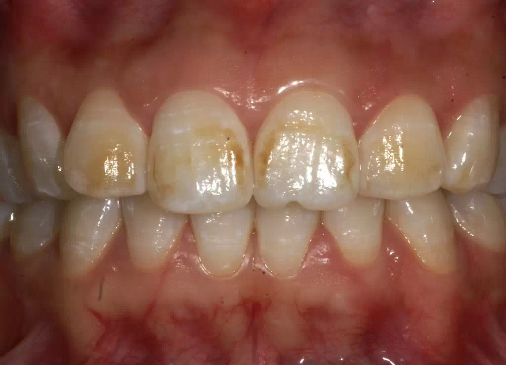 轻度氟斑牙,一般是只有牙齿颜色的轻度改变,散在的黄斑,牙齿表面的