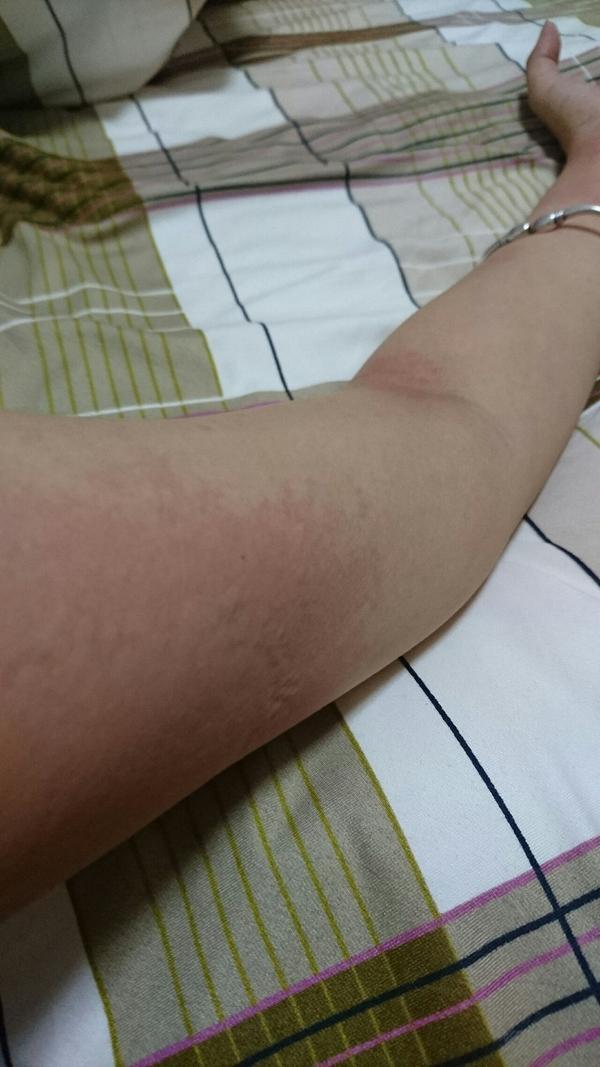 本着惜命的选择奔向医院,经确诊:急性萋殚疹.
