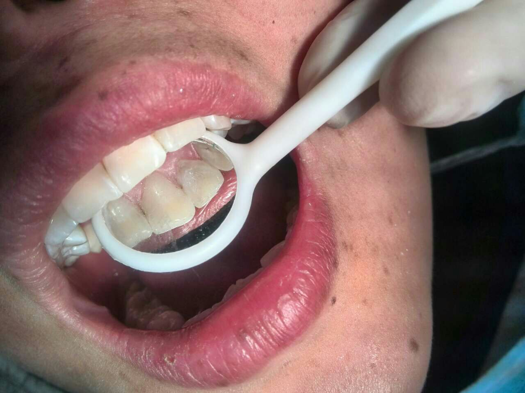 牙缝中间龋齿应该怎么处理呢?
