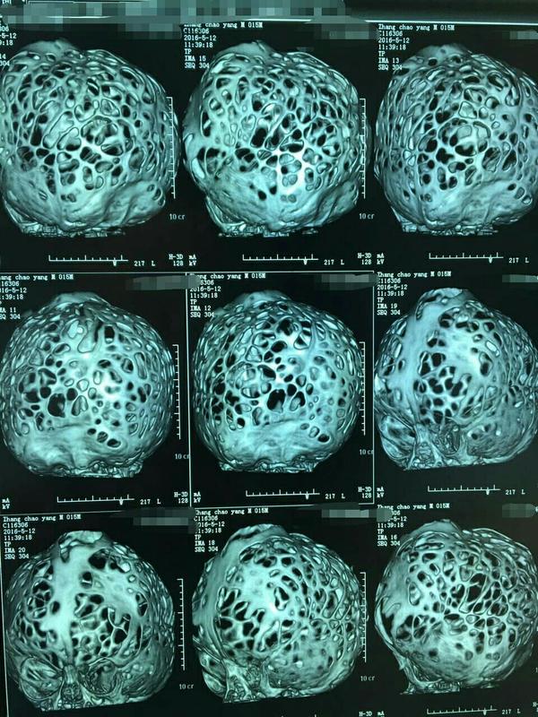 增加一张图,另一个病人,颅骨重建的,先天发育问题,少见,算不算恶心