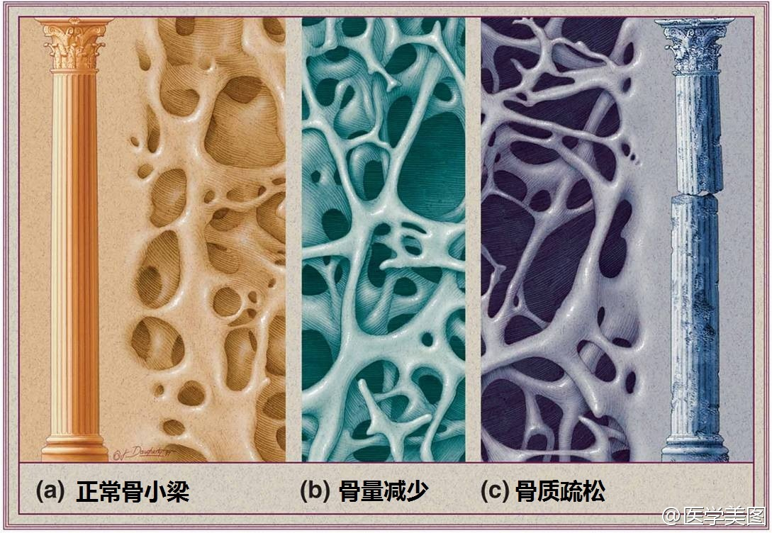 老年人骨质疏松,应该注意些什么?