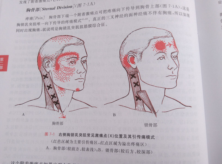 出所以然,许多医生也没有这个概念,特别是疼痛区域在头顶和前额以及