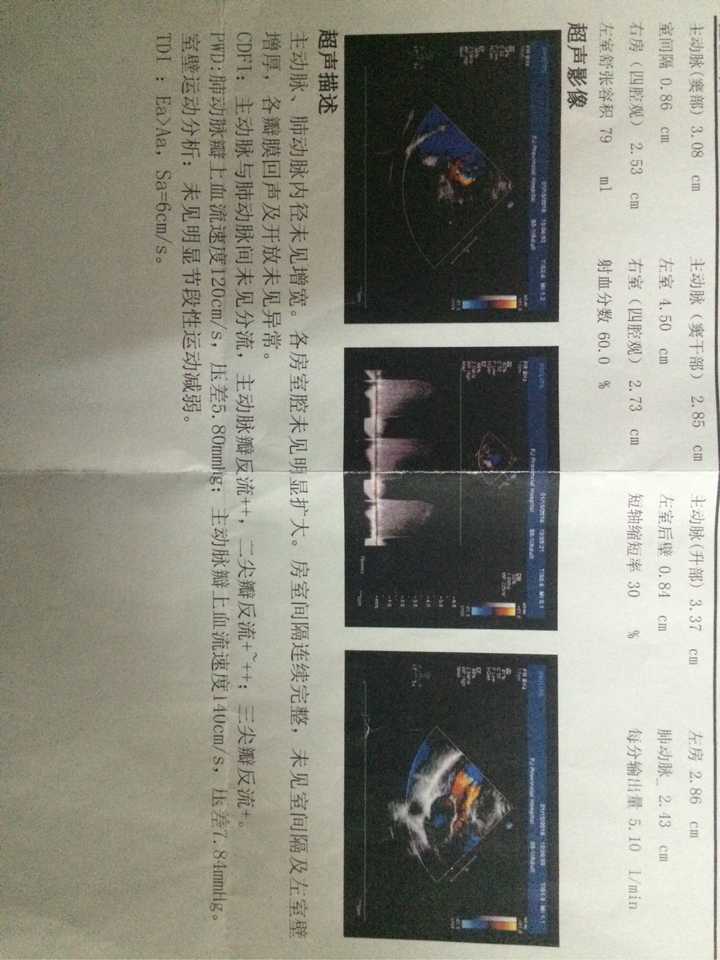 心脏彩超显示主动脉瓣返流  ,二尖瓣反流  ,这反流程度是轻度还是中度