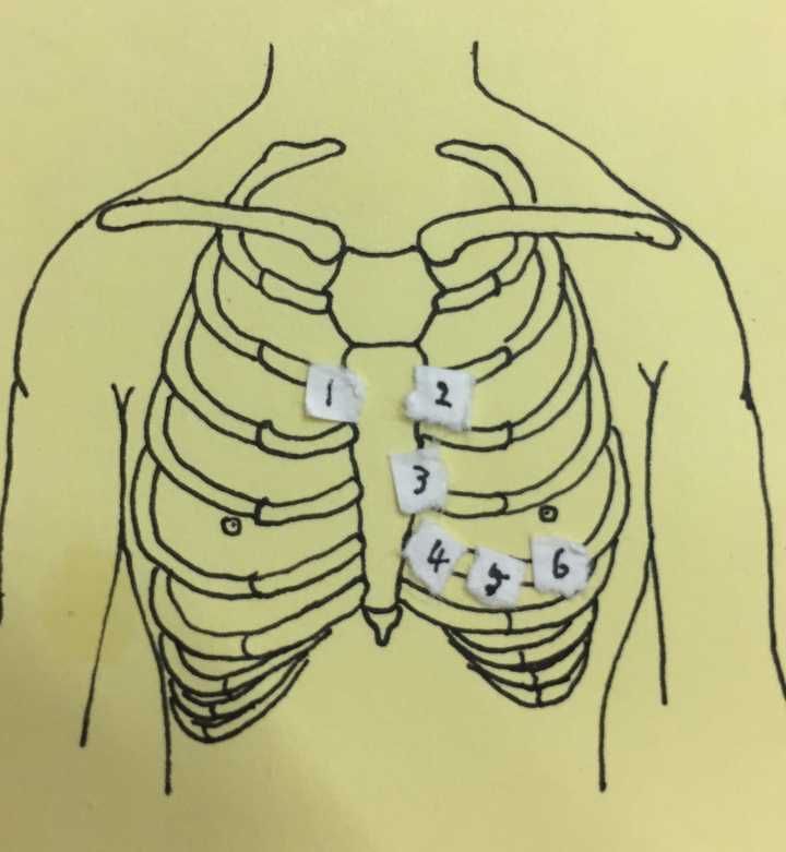 如图,alex胸前心电图导联连接的位置是这样的,不对.