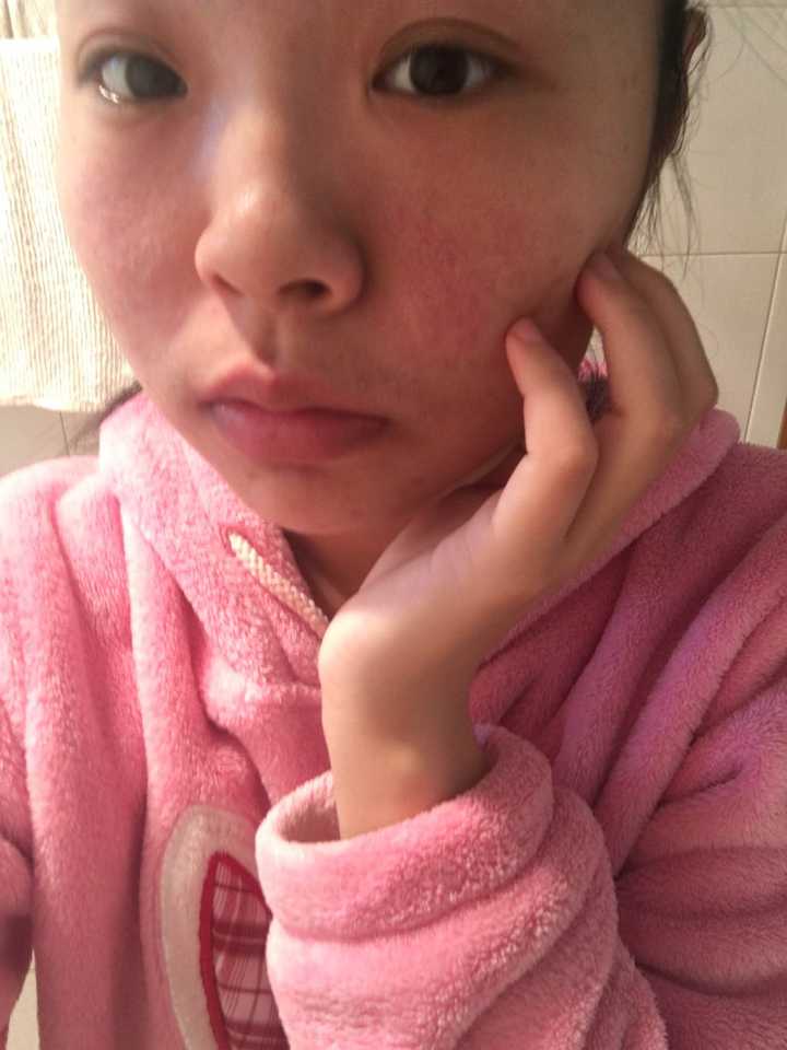 女朋友27岁,刚开始因为熬夜脸部皮肤发红干涩脱皮,怎么办?