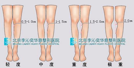 轻度o型腿:双腿并拢膝部无缝隙,测量单腿膝下内侧凹陷最大值在0.