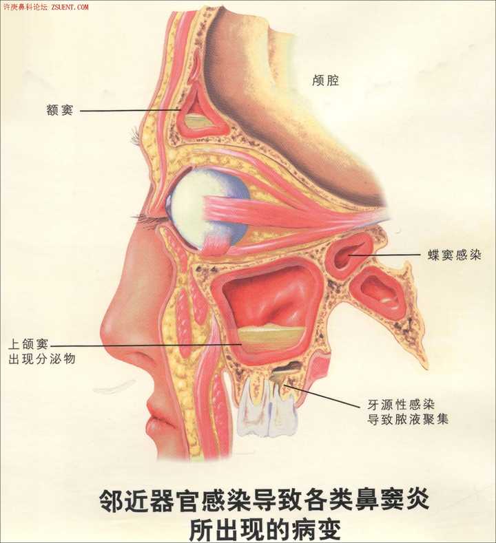 分别为:额窦,筛窦,上颌窦,蝶窦 各窦开口: 筛窦可分为前,中,后三组,前