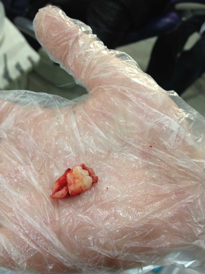 想想嘴里一个5mm的口子感觉吧,就像一个超大号的口腔溃疡,腮帮倒是没