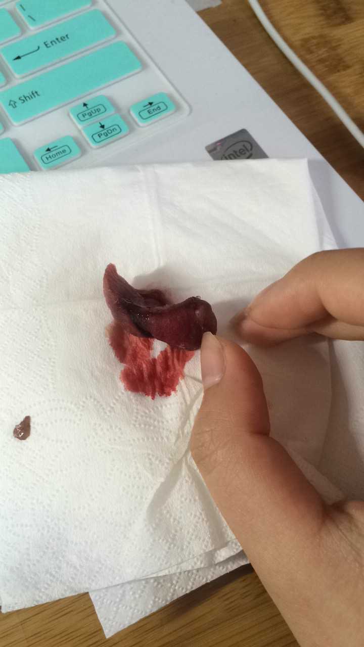 这是拔完了牙洞洞里的血凝块掉出来了,后来是我母上操刀帮我剪掉的