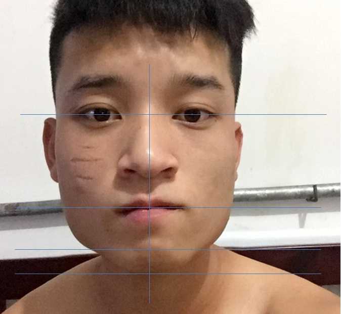 但照片中还显示了另外的问题,面部不对称,尤其是下面部.