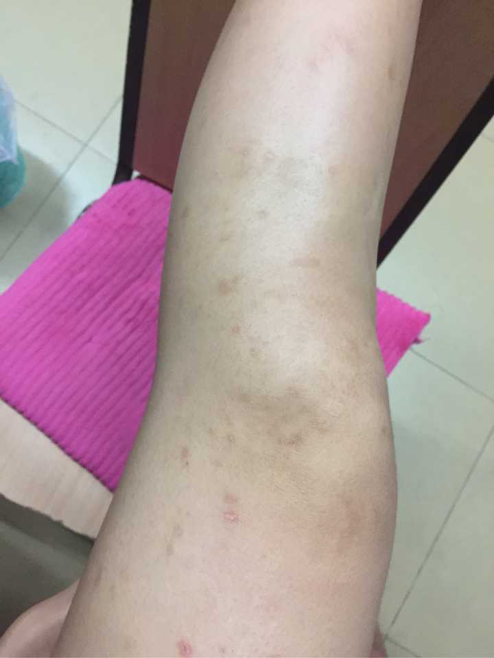 我的腿被蚊子咬得体无完肤(带图),怎样有效地消除蚊子