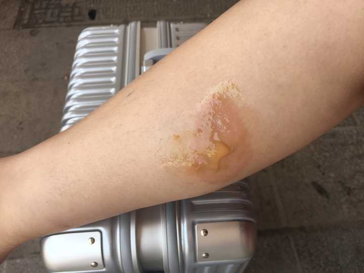 烫伤之后怎么做不会留下疤痕?