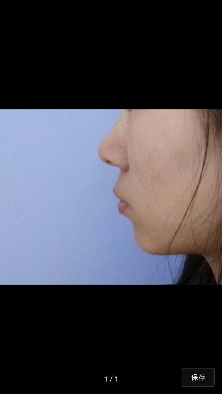 下半张脸长这样需要做正颌手术吧(×_×#?