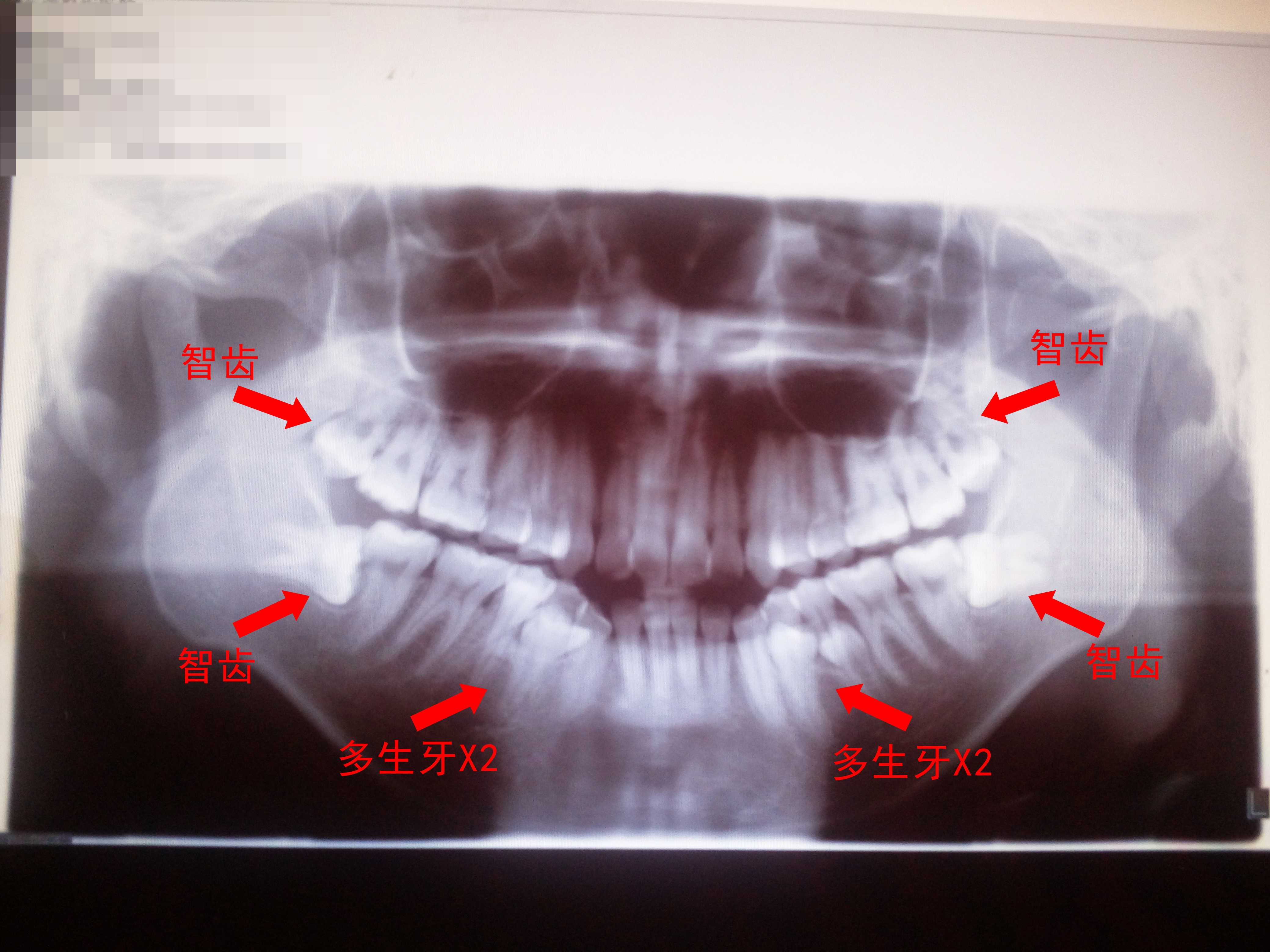 首先,被拔掉的牙都是不正常的牙,包括4颗智齿 4颗多生牙.