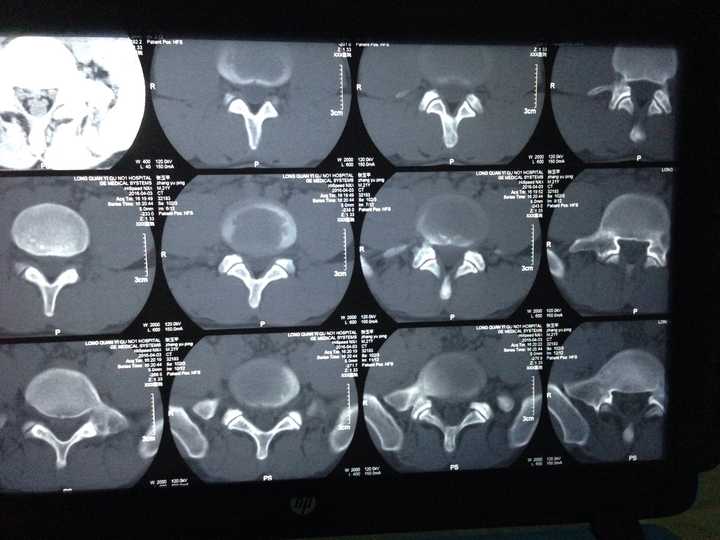 5cm,压迫硬膜囊,现在已经针灸半个月,左腿和屁股好痛啊,弯腰的时候痛