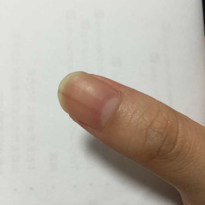 左手大拇指指甲有一条淡褐色竖线,好几年了,微量元素也正常,为什么啊?