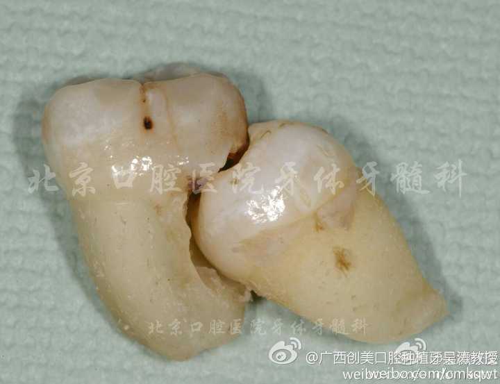 引自北京口腔医院的一例拔牙术后牙体形态可以简单明了说明
