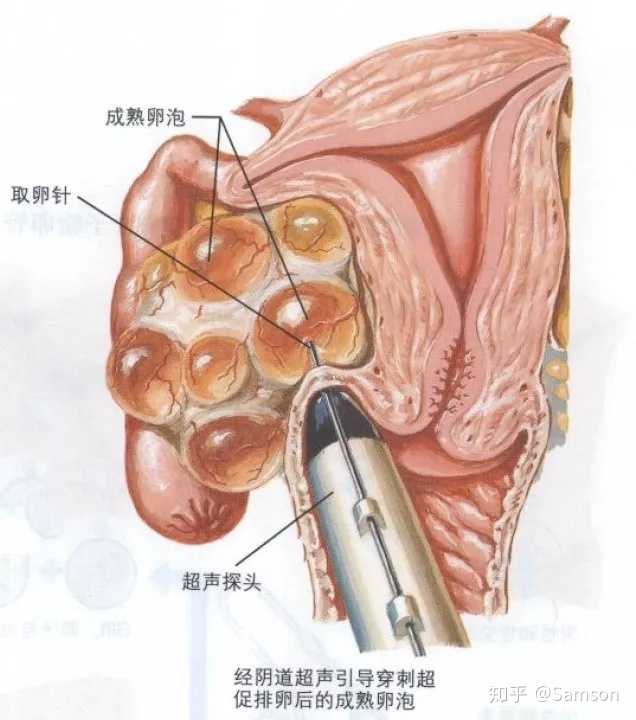 比如,一个 25 岁的女性通过 b 超检测到卵泡数量,雌激素的水平等并不