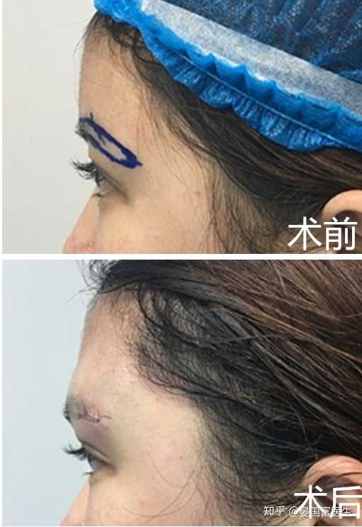 隆眉弓手术安全稳定吗,技术是不是没有隆鼻手术成熟,有什么副作用?