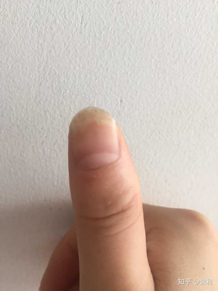 我这算是灰指甲吗有图