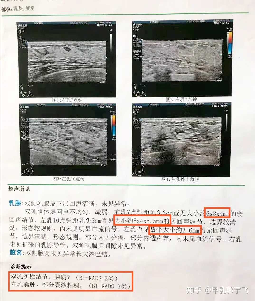 有乳腺结节必须手术别被忽悠了