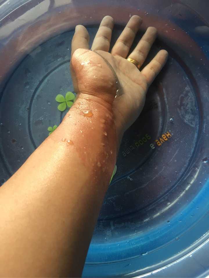 手被开水烫伤了怎么办?