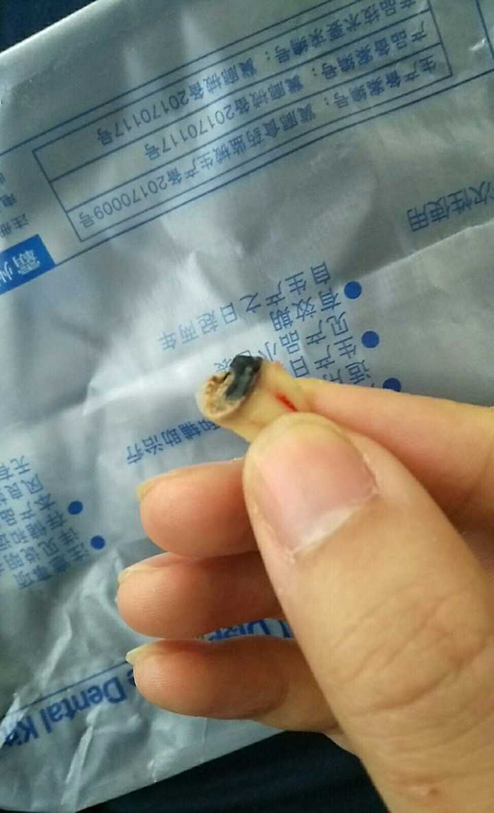 拔智齿有多痛?