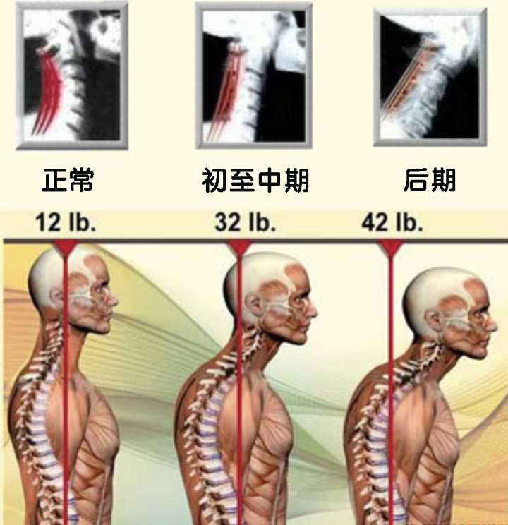 耳朵与肩膀成一直线,头部重量(~12磅)得以平均分散,颈椎弧度正常