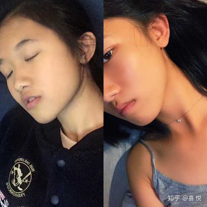 戴过牙套(矫正牙齿)的人脸型变了吗?