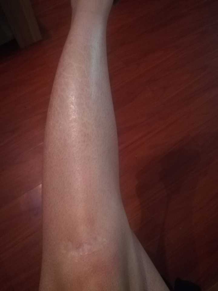 鱼鳞病能否根治?不能的话有什么措施可以改善患者状况