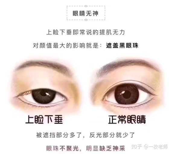 但是的一般建议轻中度做上睑提肌,重度就不适合了.