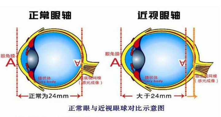 近视后如果不配戴眼镜进行矫正,会让眼睛的视觉敏感度下降,视功能减退