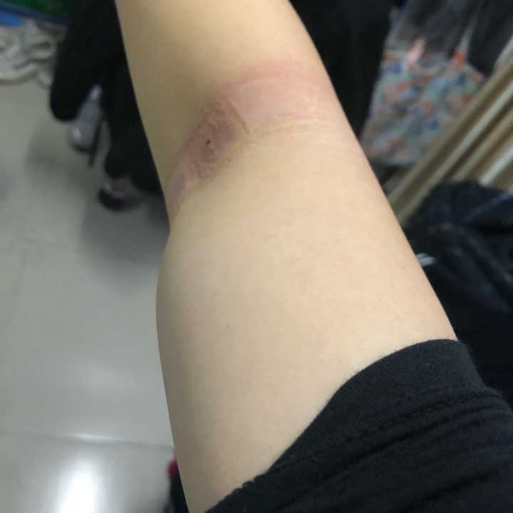 第一次献血 不小心搞得手臂肿了