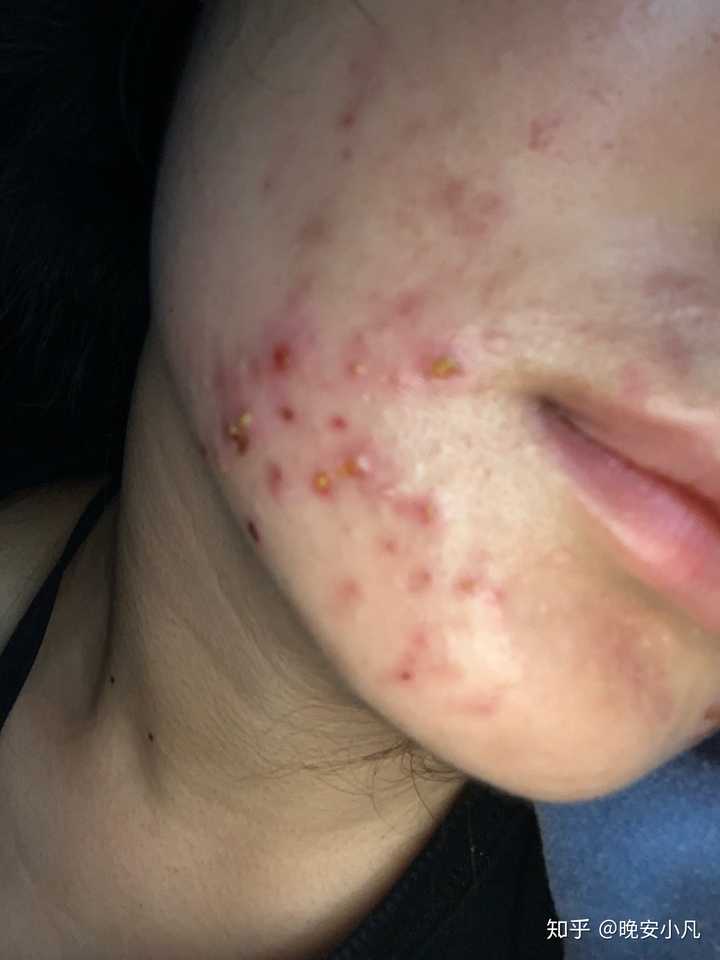 如果是闭合型粉刺不建议针清 我自己当时就是看好多人说针清对闭口很