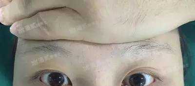 怎么区分自己是不是上睑下垂需不需要提肌什么情况下容易导致混淆和