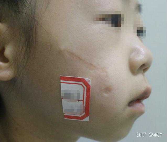缝合手术后的凹陷型疤痕该怎样去除?