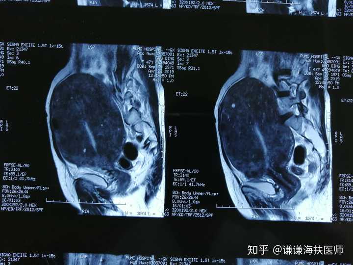 巨大子宫腺肌的磁共振图片