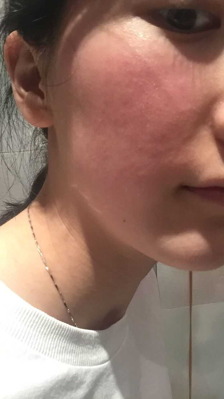 如何改善脸上皮肤特别薄,一直泛红,毛孔粗大,红血丝明显?