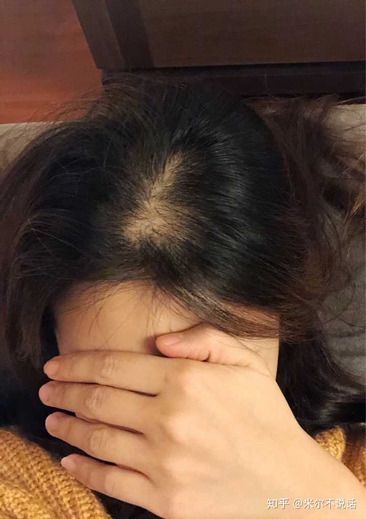 女生头顶头发少是什么体验 ?