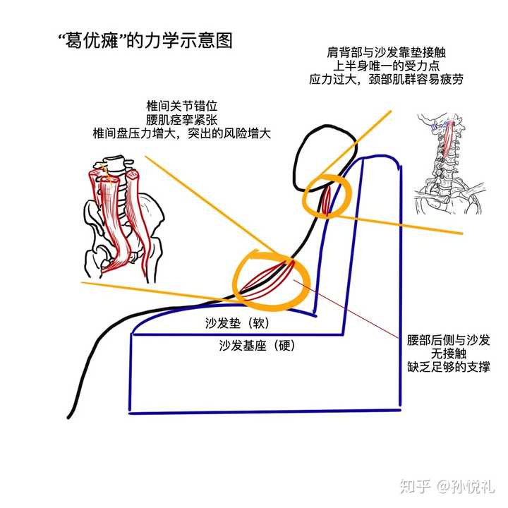 不良坐姿的腰椎受力分析示意图