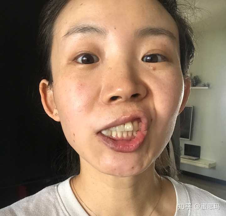 右边麻药还没退的面瘫脸