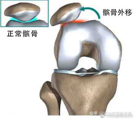 运动康复陈老师 的想法#髌骨软化症 膝盖疼痛髌骨软化最常见的
