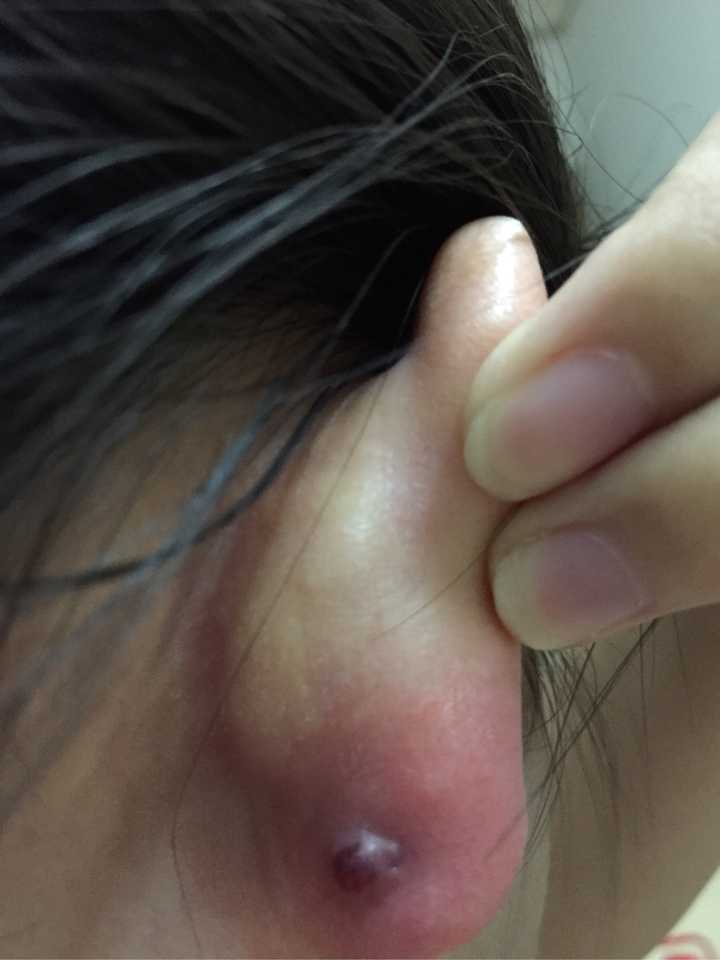 打了三个月耳洞,耳洞旁边长了一个像是血包的东西.