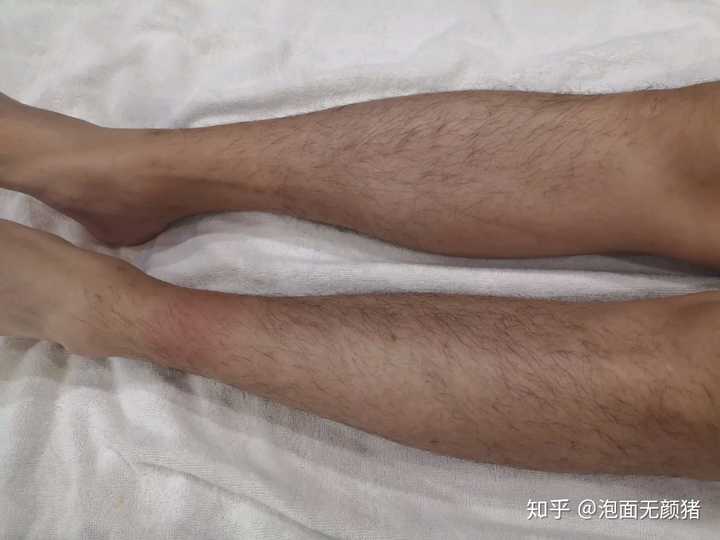 腿毛越刮越长真的不能刮吗除了激光还有没别的靠谱方法