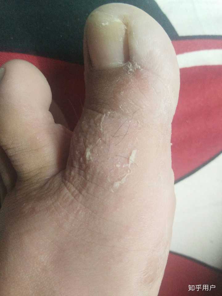 水泡型脚气和汗疱疹的区别?
